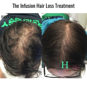 Is Covid19 Causing Hair Loss - Healthy Hair Clinic